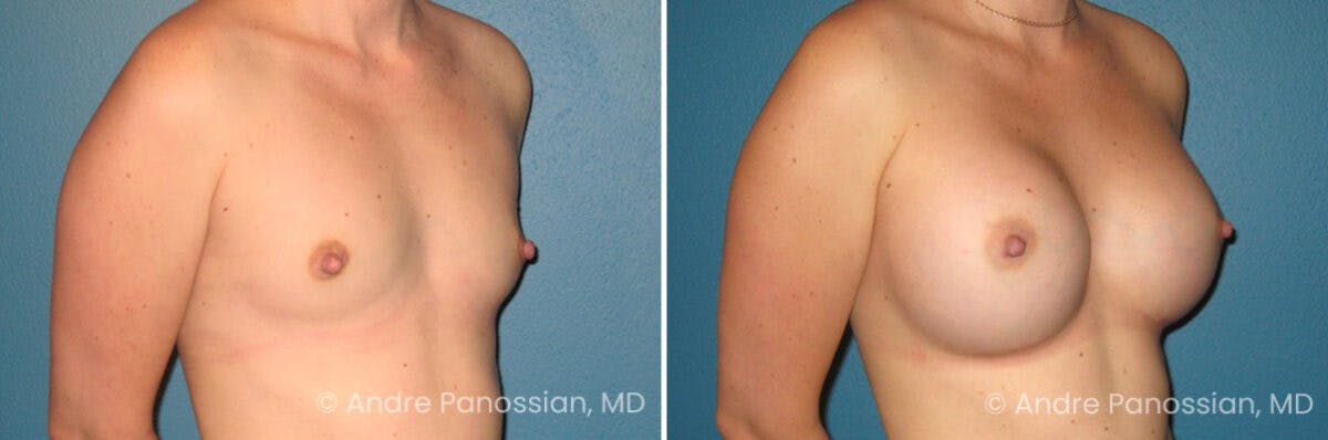 Breast Augmentation Before & After Gallery - Patient 355602 - Image 1