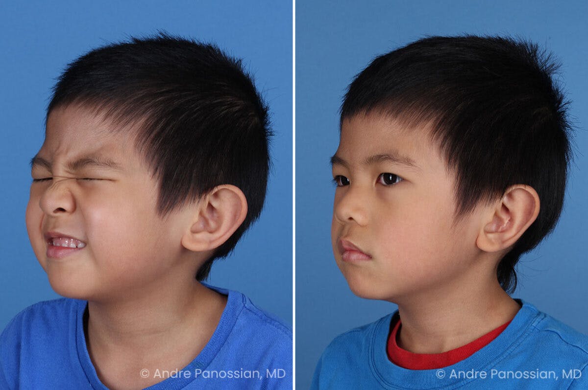 Ear Pinning (Otoplasty) Before & After Gallery - Patient 637268 - Image 2
