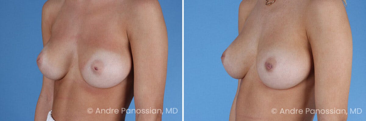 Inverted Nipple Correction Before & After Gallery - Patient 295469 - Image 2