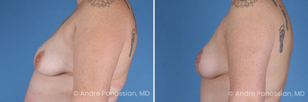 Breast Lift/Reduction Before & After Gallery - Patient 116305 - Image 5