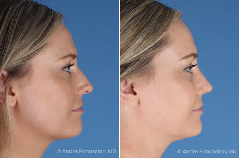 Rhinoplasty Before & After Gallery - Patient 103326 - Image 1