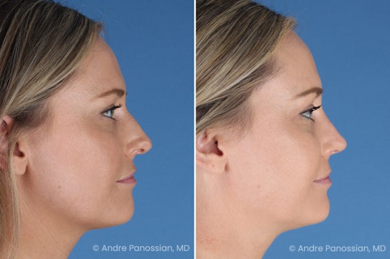 Rhinoplasty before and after — actual patient of Andre Panossian, MD