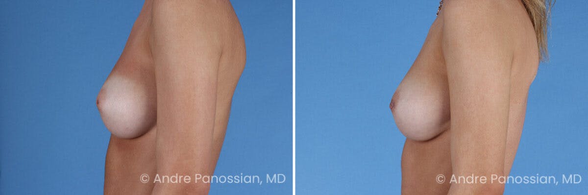 Inverted Nipple Correction Before & After Gallery - Patient 295469 - Image 3