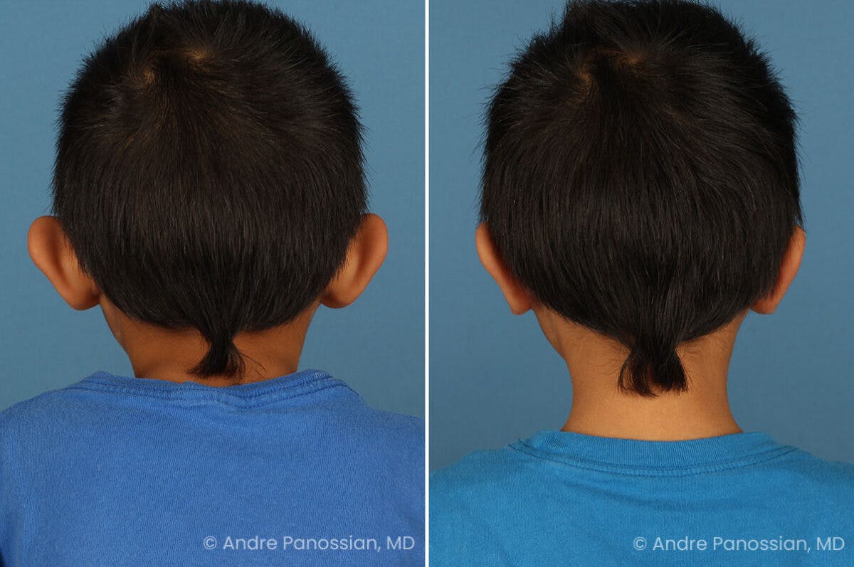 Ear Pinning (Otoplasty) Before & After Gallery - Patient 637268 - Image 3