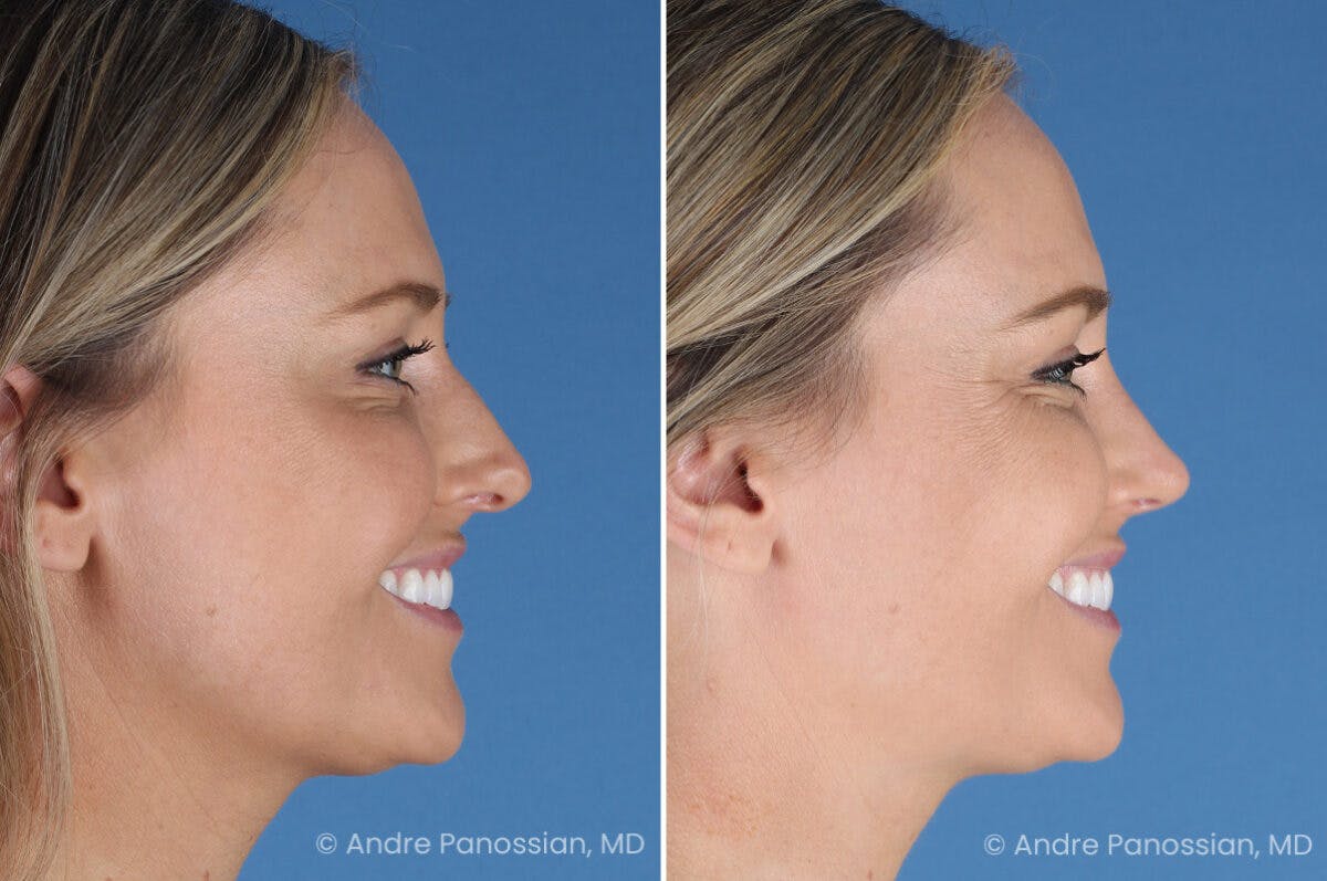 Rhinoplasty Before & After Gallery - Patient 103326 - Image 4