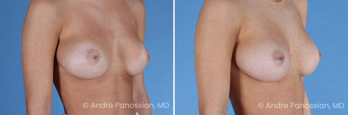 Inverted Nipple Correction Before & After Gallery - Patient 295469 - Image 4