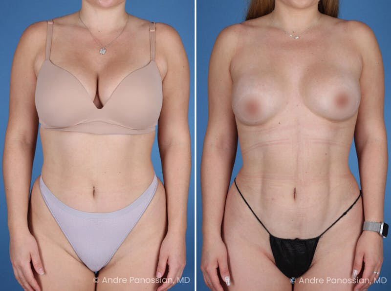 Abdominal High-Definition Liposuction Before & After Gallery - Patient 282977 - Image 1