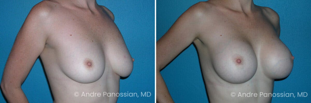 Breast Augmentation Before & After Gallery - Patient 283164 - Image 1