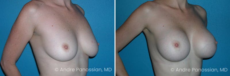 Breast Augmentation Before & After Gallery - Patient 283164 - Image 1
