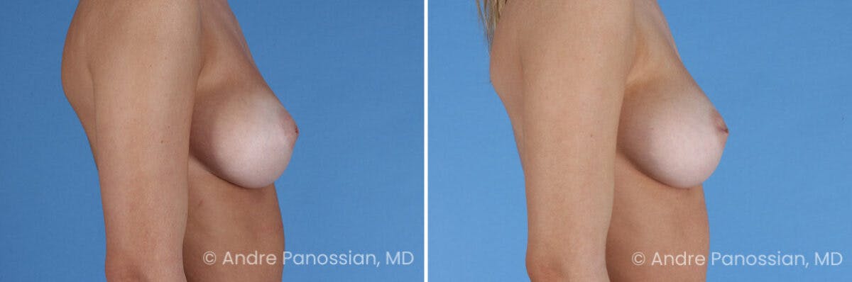 Inverted Nipple Correction Before & After Gallery - Patient 295469 - Image 5