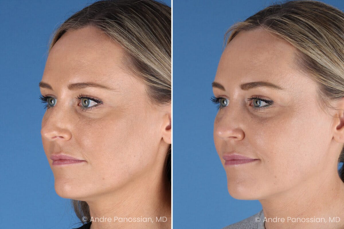 Rhinoplasty Before & After Gallery - Patient 103326 - Image 5