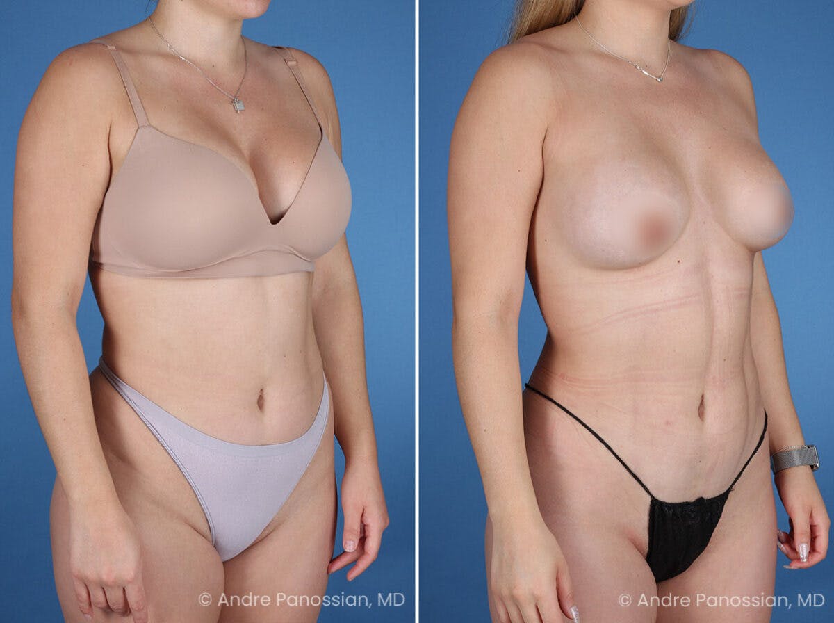 Abdominal High-Definition Liposuction Before & After Gallery - Patient 282977 - Image 2