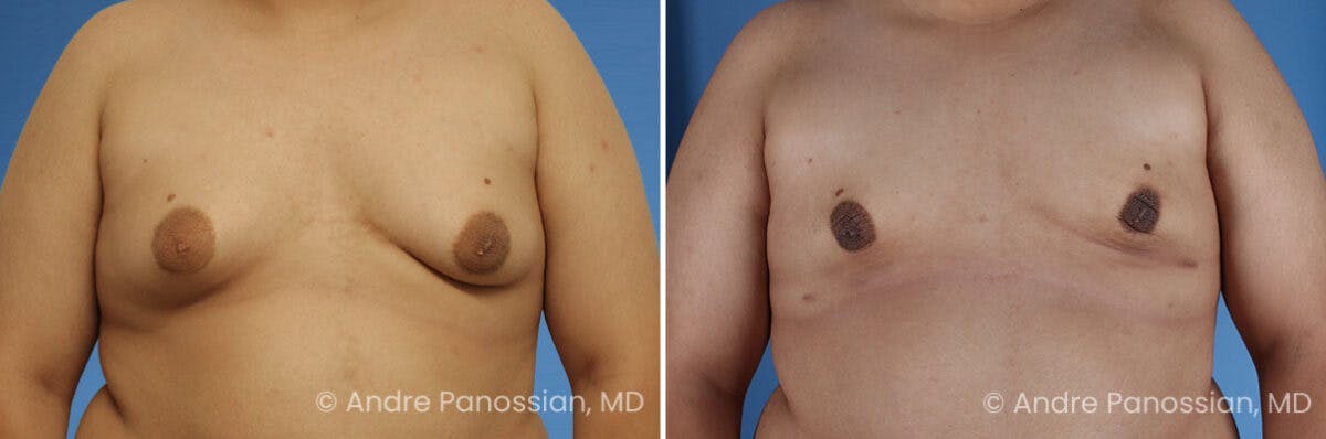 Male Breast Reduction (Gynecomastia) Before & After Gallery - Patient 370565 - Image 1