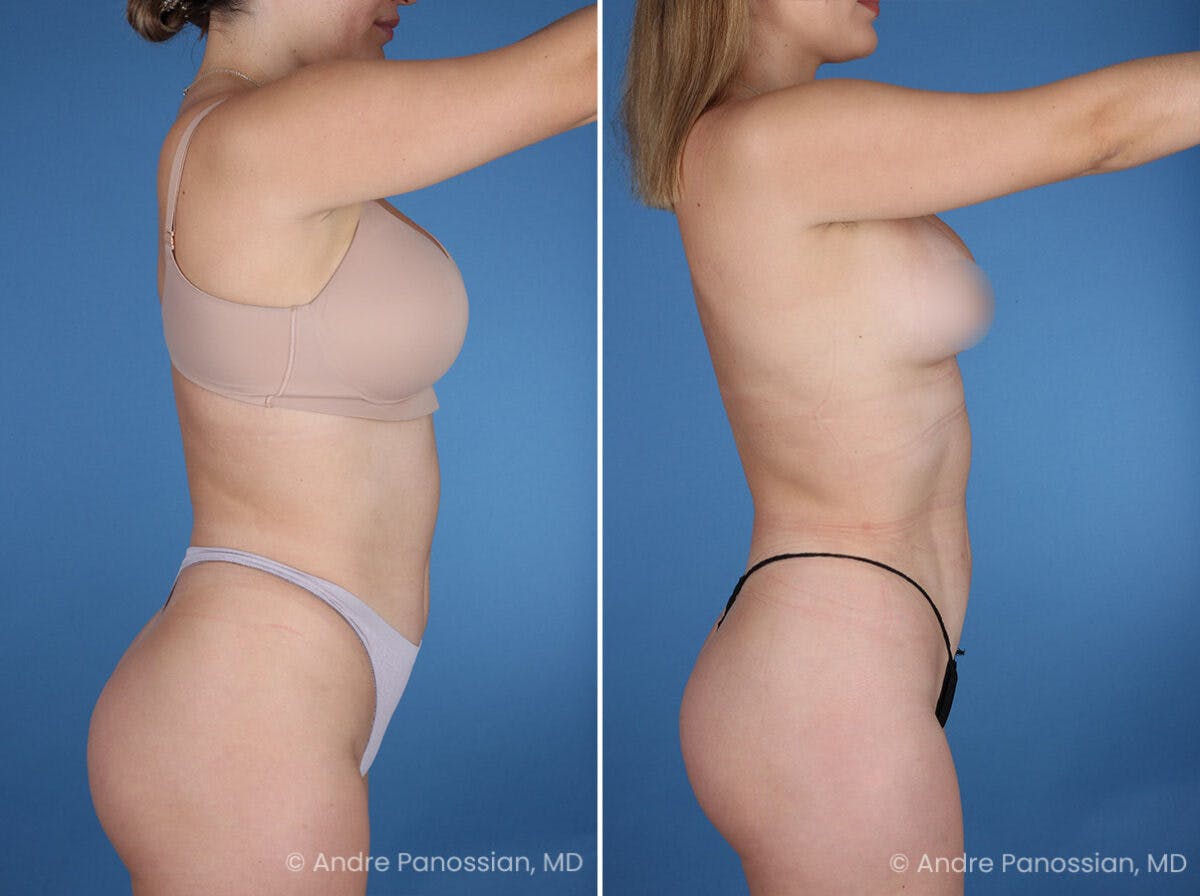 Abdominal High-Definition Liposuction Before & After Gallery - Patient 282977 - Image 3