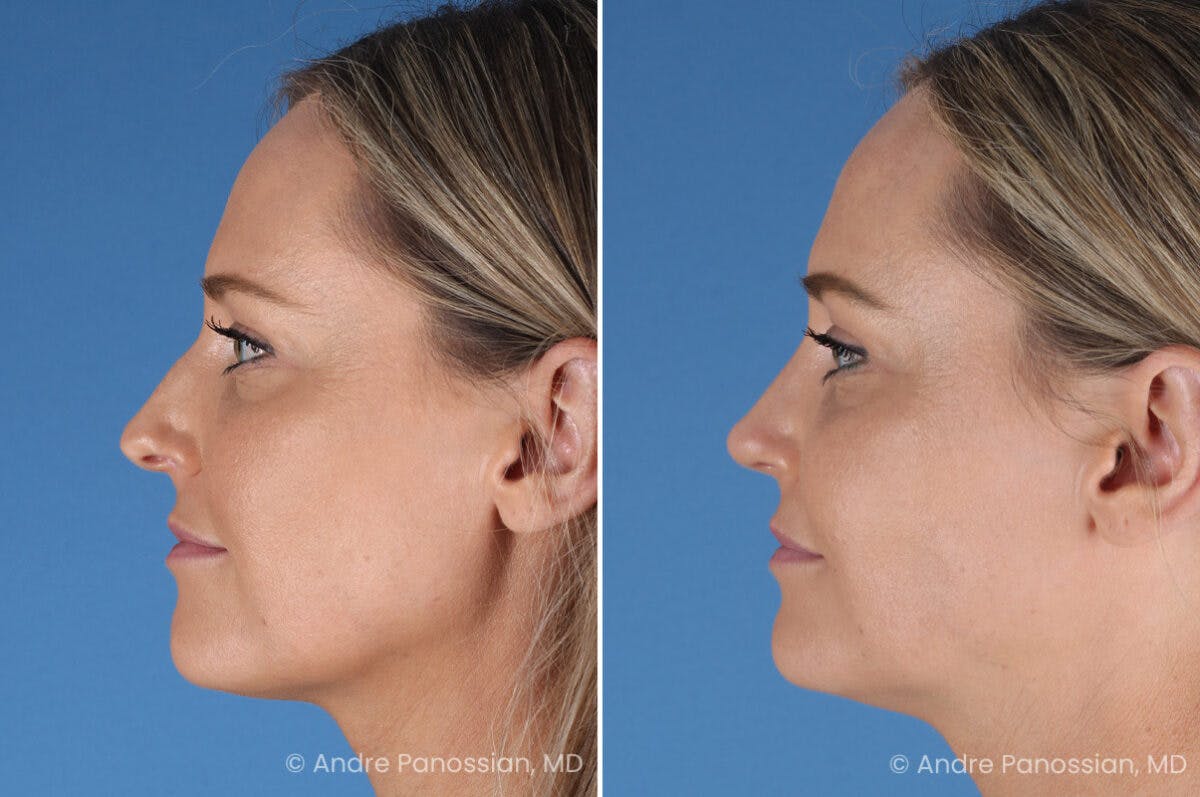 Rhinoplasty Before & After Gallery - Patient 103326 - Image 6