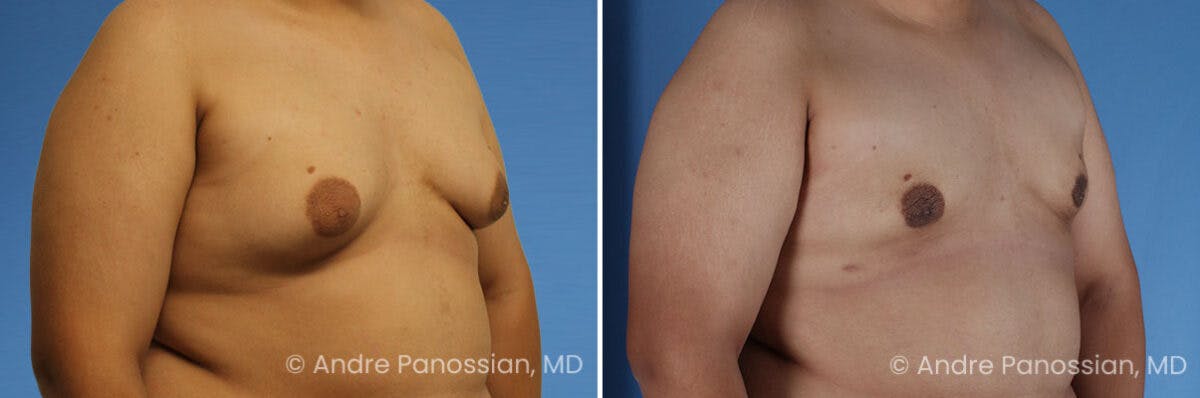 Male Breast Reduction (Gynecomastia) Before & After Gallery - Patient 370565 - Image 2