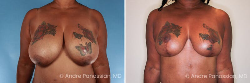 Breast Lift/Reduction Before & After Gallery - Patient 379916 - Image 1