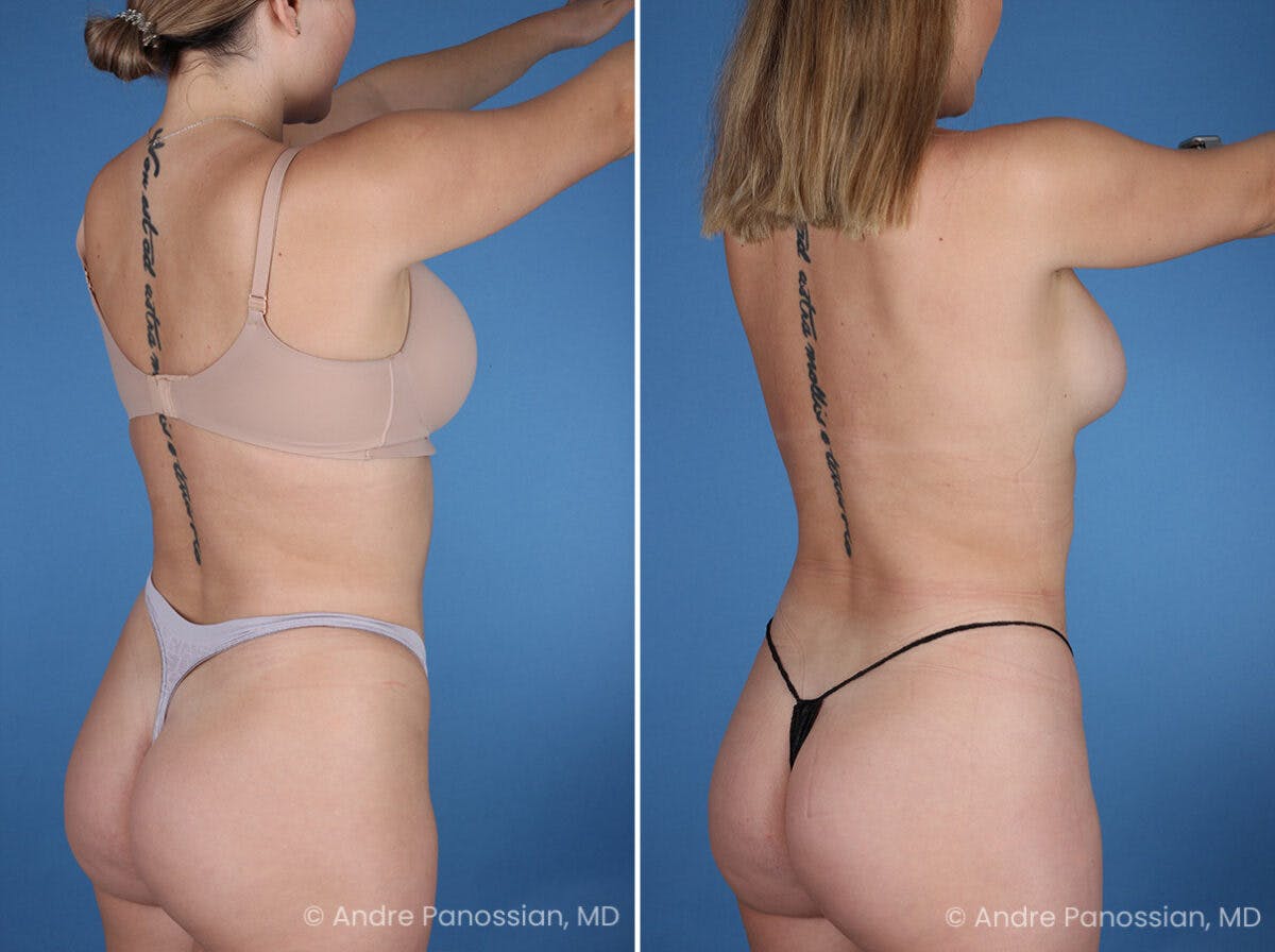 Abdominal High-Definition Liposuction Before & After Gallery - Patient 282977 - Image 4