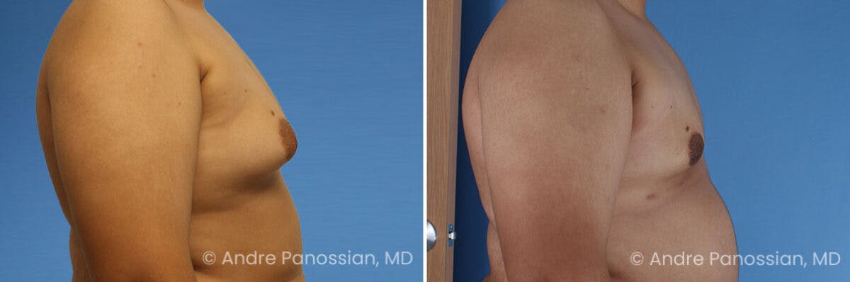 Male Breast Reduction (Gynecomastia) Before & After Gallery - Patient 370565 - Image 3