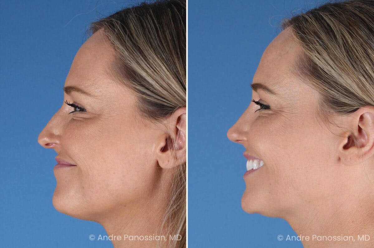 Rhinoplasty Before & After Gallery - Patient 103326 - Image 7
