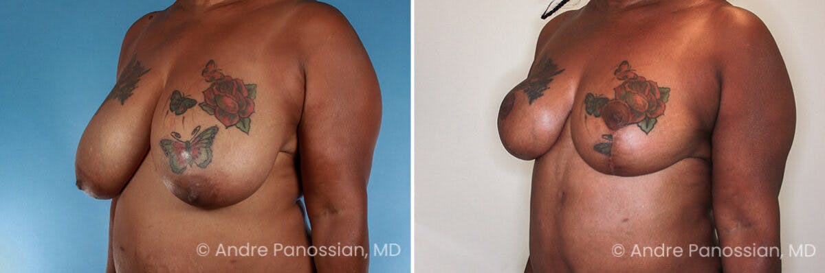 Breast Lift/Reduction Before & After Gallery - Patient 379916 - Image 2