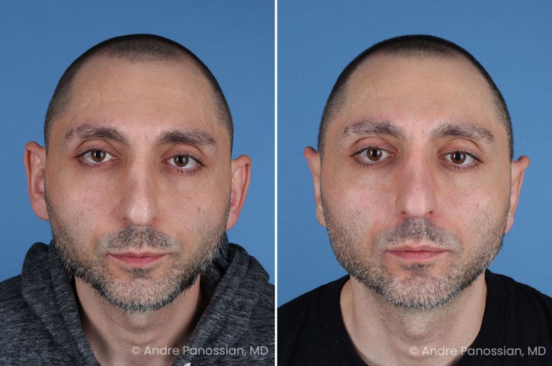 Ear Pinning (Otoplasty) Before & After Gallery - Patient 349039 - Image 1