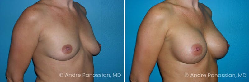 Breast Augmentation Before & After Gallery - Patient 355170 - Image 1