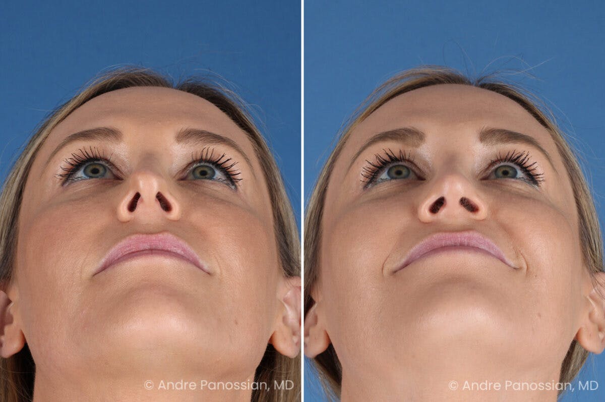 Rhinoplasty Before & After Gallery - Patient 103326 - Image 8
