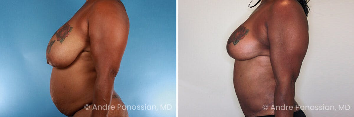 Breast Lift/Reduction Before & After Gallery - Patient 379916 - Image 3