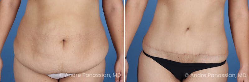 Tummy Tuck Before & After Gallery - Patient 466198 - Image 1