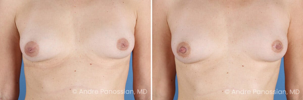 Inverted Nipple Correction Before & After Gallery - Patient 156515 - Image 1