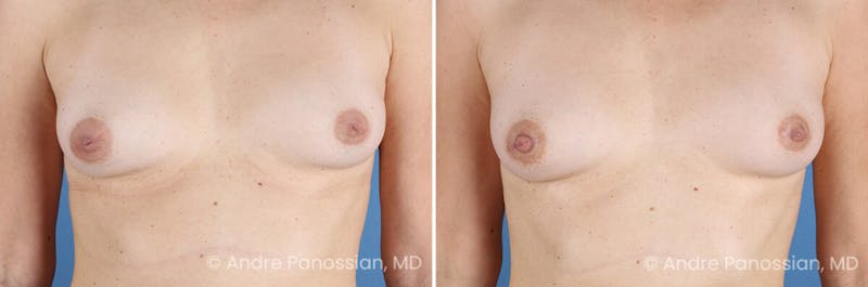 Inverted Nipple Correction Before & After Gallery - Patient 156515 - Image 1