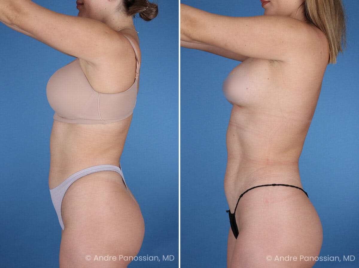 Abdominal High-Definition Liposuction Before & After Gallery - Patient 282977 - Image 6