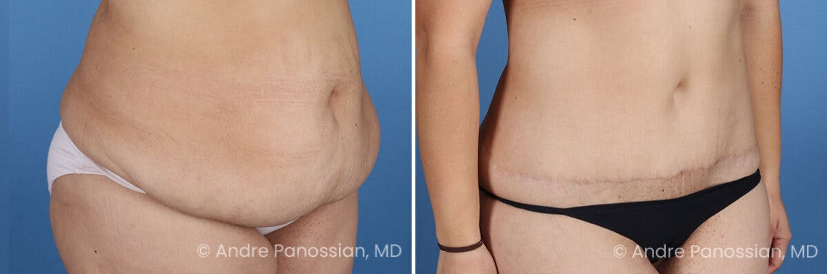Tummy Tuck Before & After Gallery - Patient 466198 - Image 2