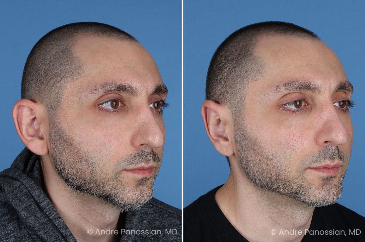 Ear Pinning (Otoplasty) Before & After Gallery - Patient 349039 - Image 2