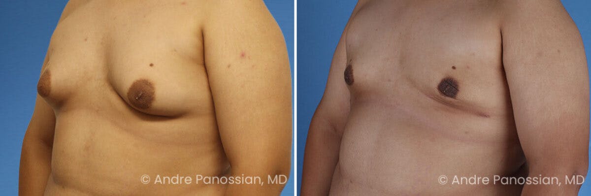 Male Breast Reduction (Gynecomastia) Before & After Gallery - Patient 370565 - Image 5
