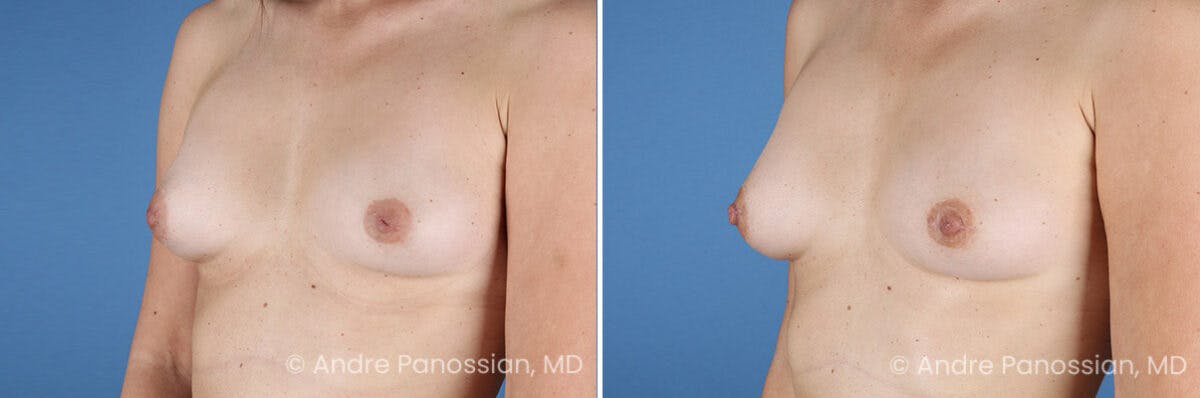 Inverted Nipple Correction Before & After Gallery - Patient 156515 - Image 2