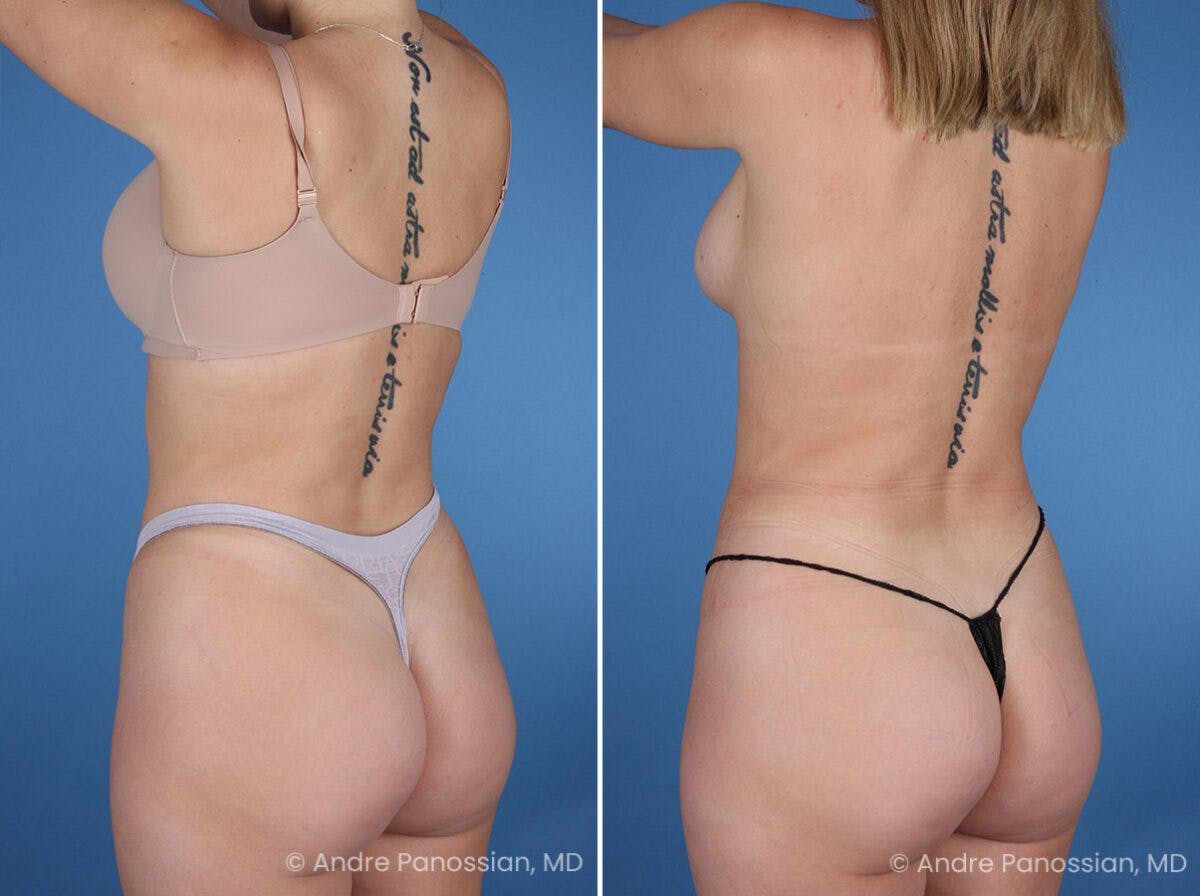 Abdominal High-Definition Liposuction Before & After Gallery - Patient 282977 - Image 7