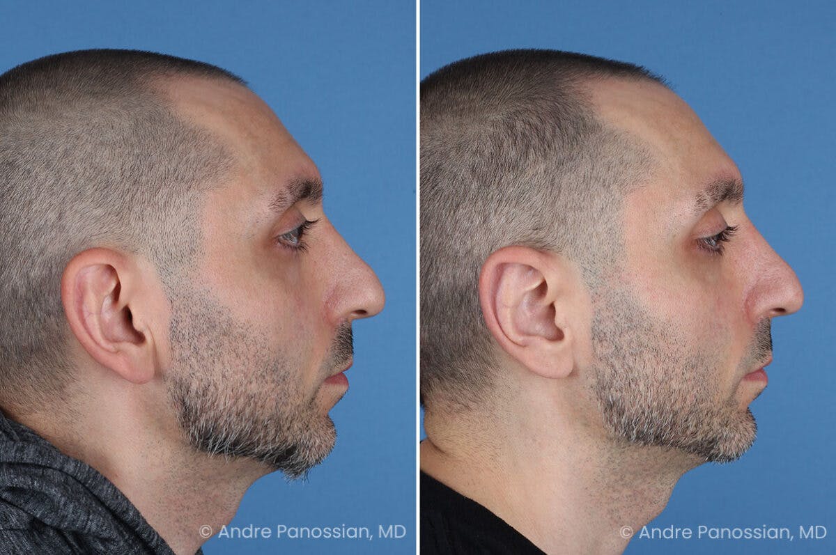 Ear Pinning (Otoplasty) Before & After Gallery - Patient 349039 - Image 3