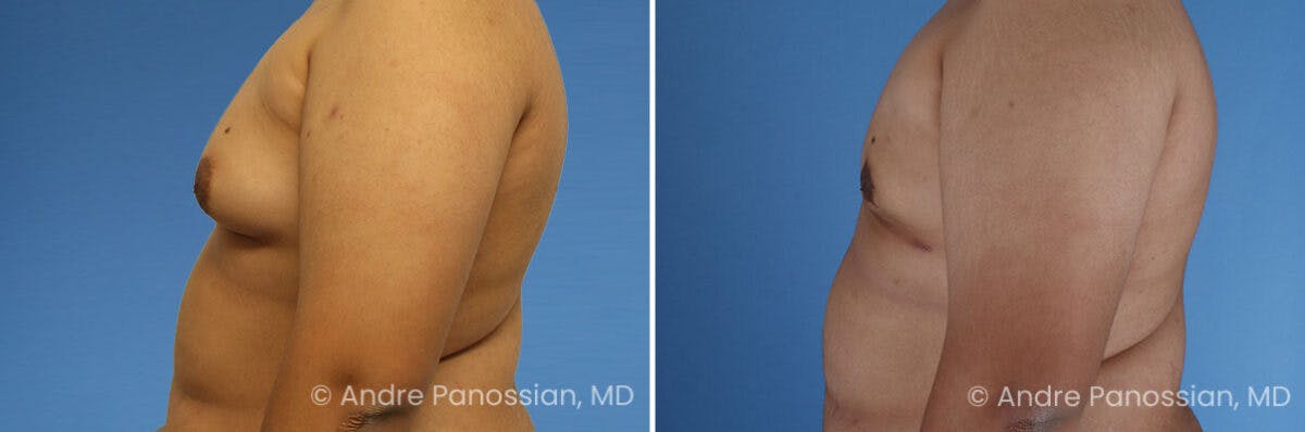 Male Breast Reduction (Gynecomastia) Before & After Gallery - Patient 370565 - Image 6