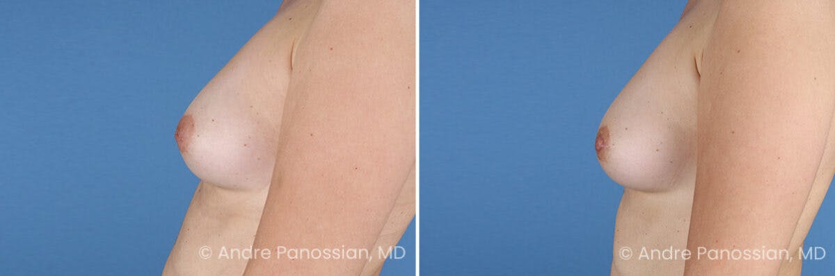 Inverted Nipple Correction Before & After Gallery - Patient 156515 - Image 3