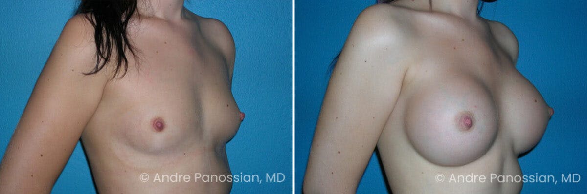 Breast Augmentation Before & After Gallery - Patient 123754 - Image 1