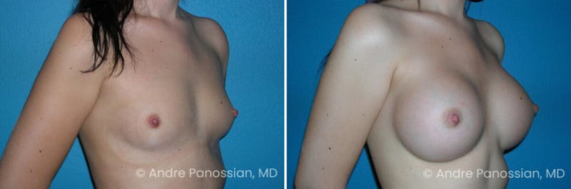 Breast Augmentation Before & After Gallery - Patient 123754 - Image 1