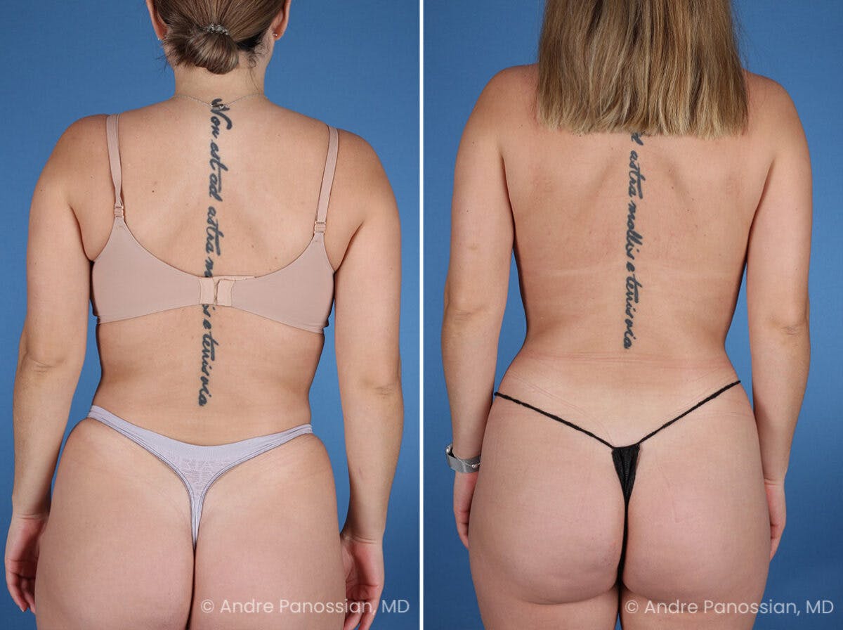 Abdominal High-Definition Liposuction Before & After Gallery - Patient 282977 - Image 8