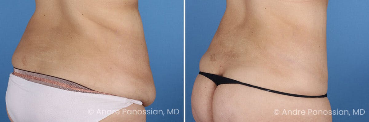 Tummy Tuck Before & After Gallery - Patient 466198 - Image 4