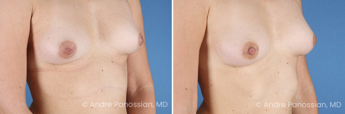 Inverted Nipple Correction Before & After Gallery - Patient 156515 - Image 4