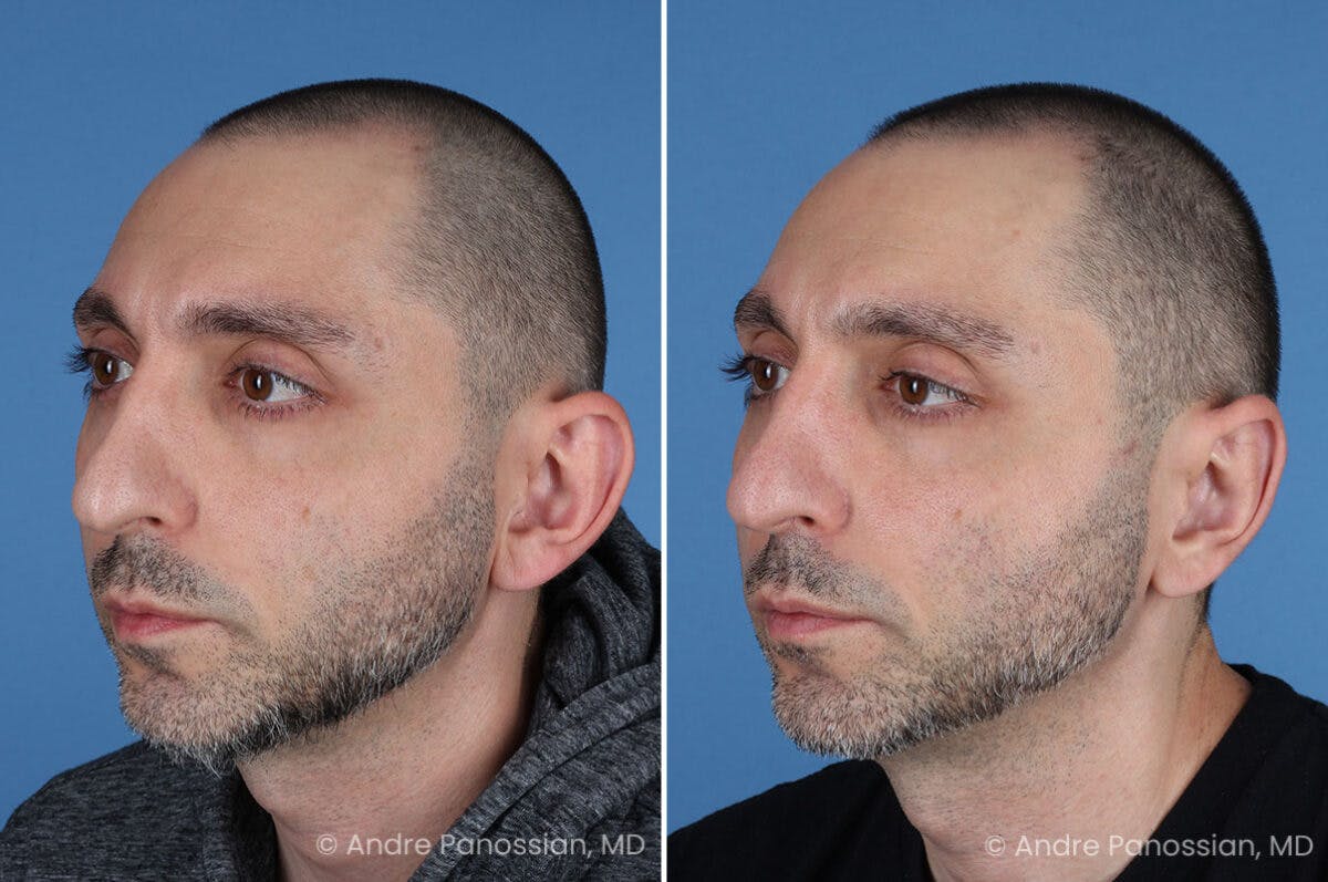 Ear Pinning (Otoplasty) Before & After Gallery - Patient 349039 - Image 4