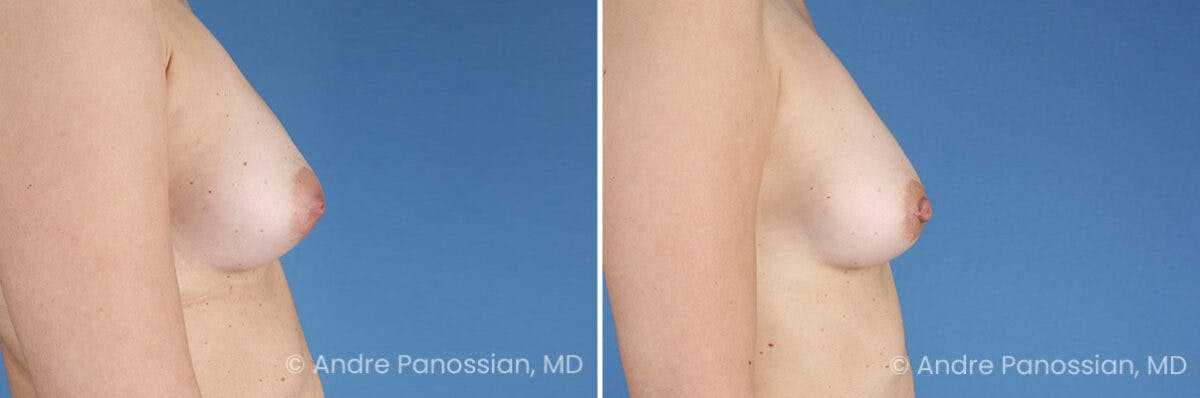 Inverted Nipple Correction Before & After Gallery - Patient 156515 - Image 5
