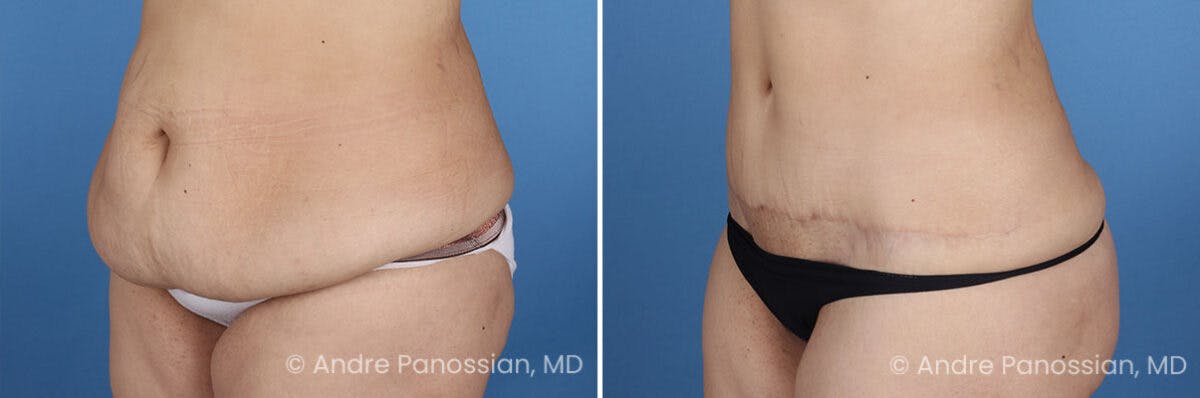 Tummy Tuck Before & After Gallery - Patient 466198 - Image 5