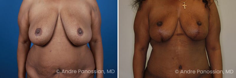 Breast Lift/Reduction Before & After Gallery - Patient 736829 - Image 1